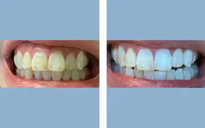 Before and After